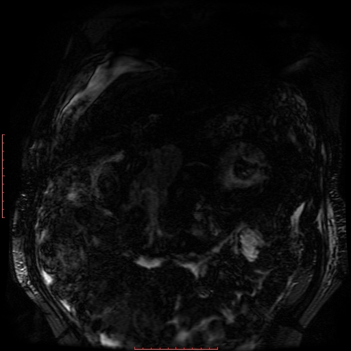 File:Acute necrotizing pancreatitis (Radiopaedia 28194-28448 Coronal MRCP 80).jpg