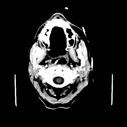 File:Acute necrotizing toxoplasma encephalitis (Radiopaedia 10683-11150 C+ arterial phase 33).jpg