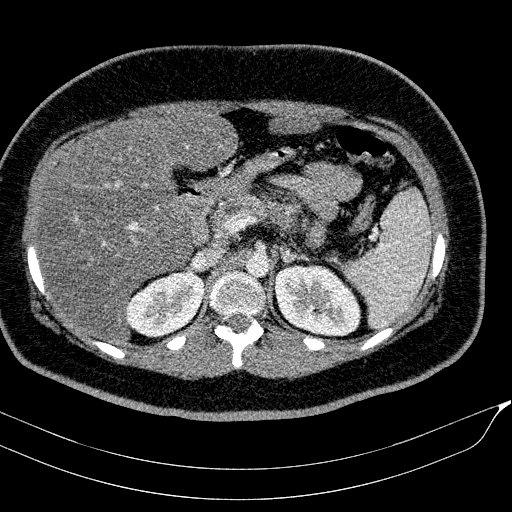 Acute on chronic pancreatitis (Radiopaedia 80902-94423 Axial C+ portal venous phase 53).jpg