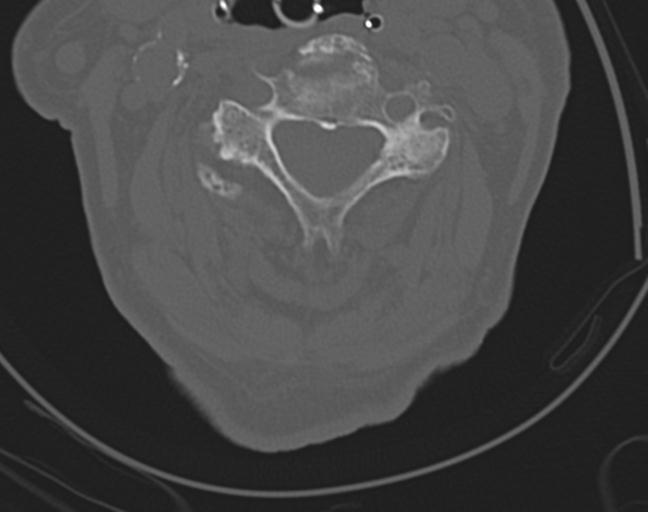 Acute on chronic subdural hematoma and thoracic vertebral injury in a multitrauma patient (Radiopaedia 31698-32619 Axial bone window 29).jpg