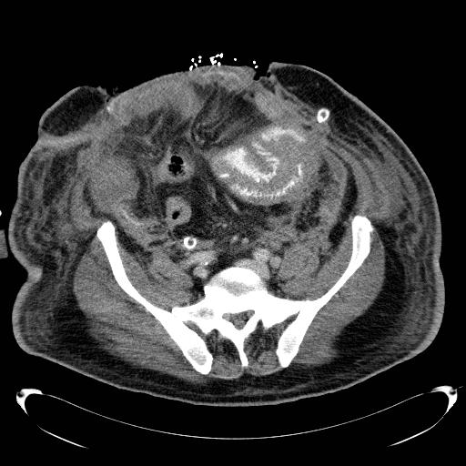 Acute pancreatic necrosis (Radiopaedia 13560-18503 Axial C+ portal venous phase 59).jpg
