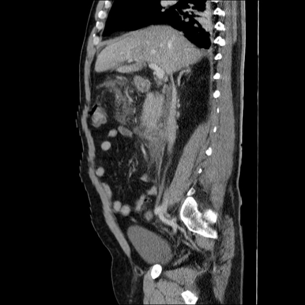 Acute pancreatitis (Radiopaedia 26663-26813 Sagittal C+ portal venous phase 30).jpg