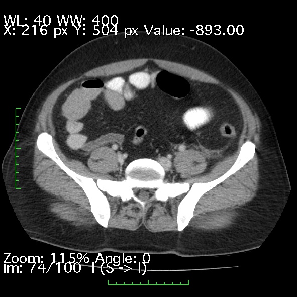 Acute pancreatitis (Radiopaedia 34043-35276 Axial C+ portal venous phase 74).jpg