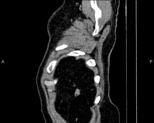 Acute pancreatitis (Radiopaedia 85146-100701 Sagittal C+ portal venous phase 93).jpg