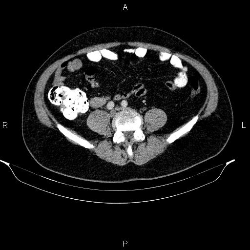Acute pancreatitis (Radiopaedia 85390-101010 Axial C+ portal venous phase 72).jpg