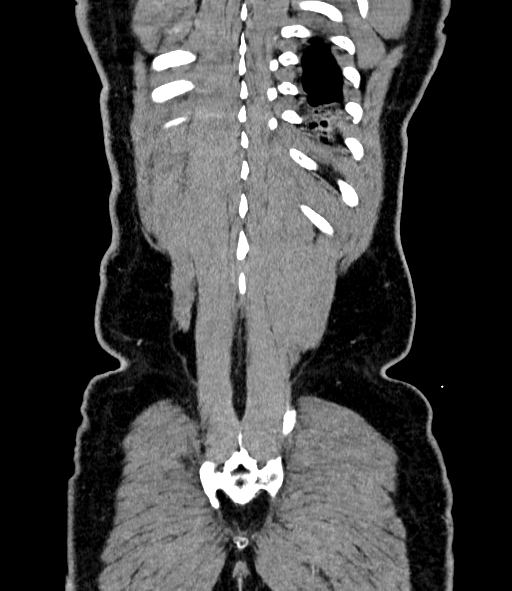 Acute pancreatitis (Radiopaedia 87428-103757 Coronal C+ portal venous phase 84).jpg