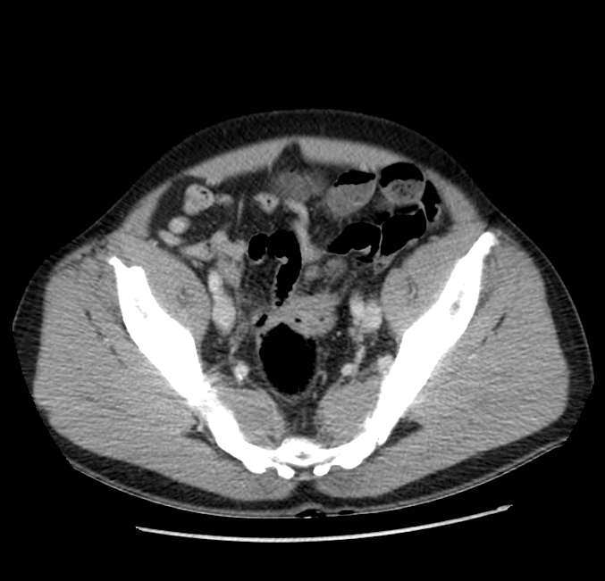 Acute pancreatitis - Balthazar E (Radiopaedia 23080-23110 Axial C+ portal venous phase 61).jpg