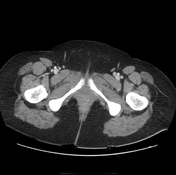Acute pancreatitis - Balthazar E (Radiopaedia 29016-29377 Axial C+ portal venous phase 79).png