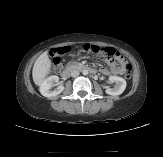 Acute pancreatitis - Balthazar E - post ERCP (Radiopaedia 27562-27772 Axial C+ portal venous phase 35).png