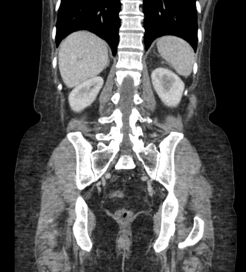 Acute pancreatitis - Balthazar E - post ERCP (Radiopaedia 27562-27772 Coronal C+ portal venous phase 65).png
