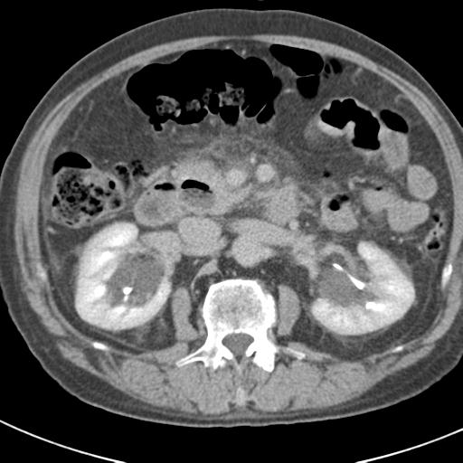 Acute pancreatitis and walled-off necrosis (Radiopaedia 29888-30403 Axial C+ delayed 36).jpg