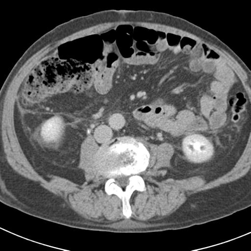 Acute pancreatitis and walled-off necrosis (Radiopaedia 29888-30403 Axial C+ delayed 47).jpg