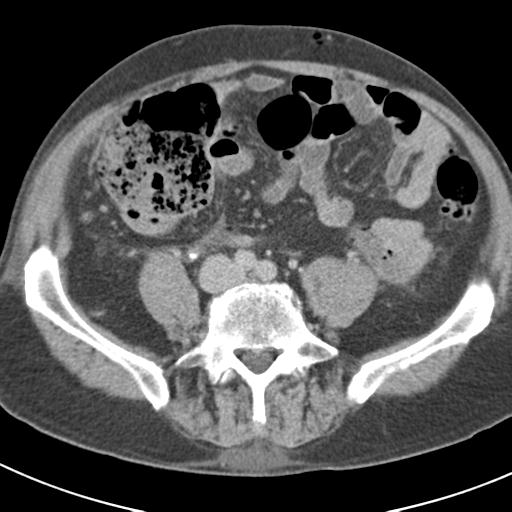 File:Acute pancreatitis and walled-off necrosis (Radiopaedia 29888-30403 Axial C+ delayed 56).jpg