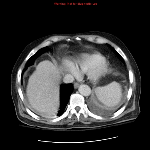 File:Acute pancreatitis with incidental pancreatic lipoma (Radiopaedia 10190-10730 Axial C+ portal venous phase 6).jpg