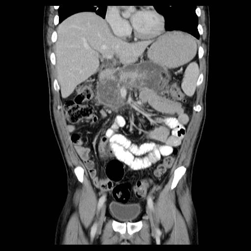 File:Acute pancreatitis with walled off pancreatic necrosis (Radiopaedia 6438-7797 Coronal C+ portal venous phase 1).jpg