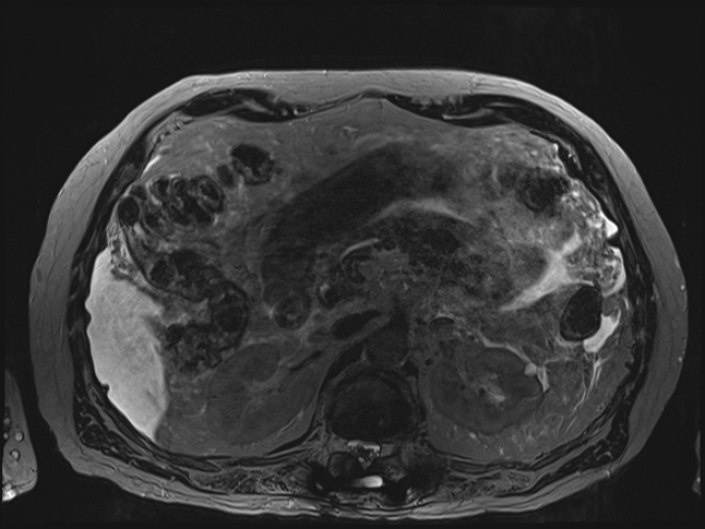 Acute portal vein thrombosis (Radiopaedia 73198-83925 Axial Heavily T2 thin cuts 41).jpg