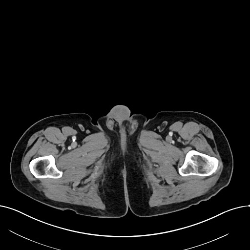 File:Acute renal infarction (Radiopaedia 59375-66736 Axial C+ portal venous phase 137).jpg