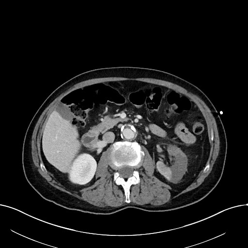 Acute renal infarction (Radiopaedia 59375-66736 Axial C+ portal venous phase 41).jpg