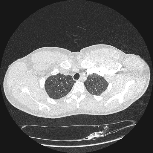 Acute segmental pulmonary emboli and pulmonary infarction (Radiopaedia 62264-70444 Axial lung window 22).jpg