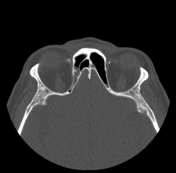 Acute sinusitis (Radiopaedia 23161-23215 Axial bone window 58).jpg