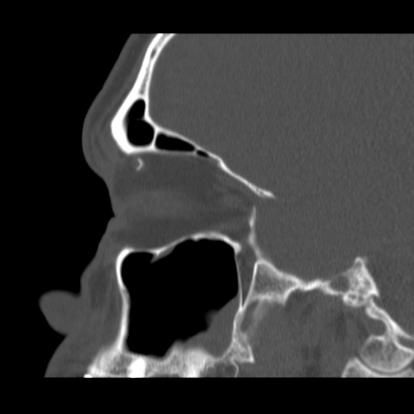 Acute sinusitis (Radiopaedia 23161-23215 Sagittal bone window 23).jpg