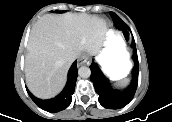 Acute small bowel (ileal) volvulus (Radiopaedia 71740-82139 Axial C+ portal venous phase 45).jpg