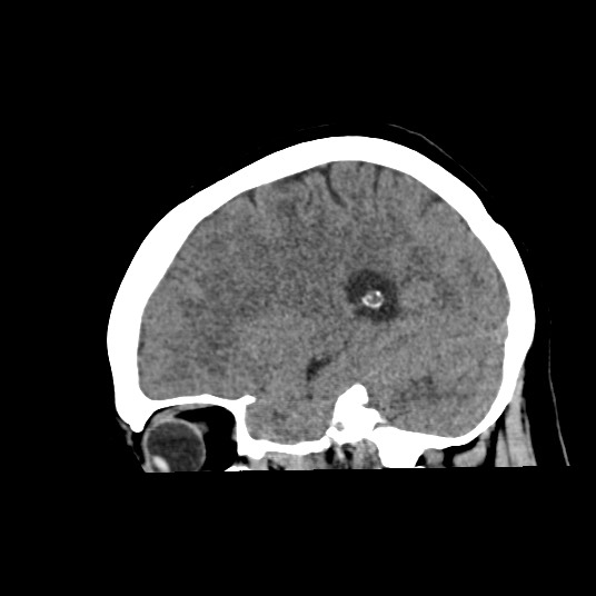 Acute subarachnoid hemorrhage and accessory anterior cerebral artery (Radiopaedia 69231-79008 Sagittal non-contrast 21).jpg