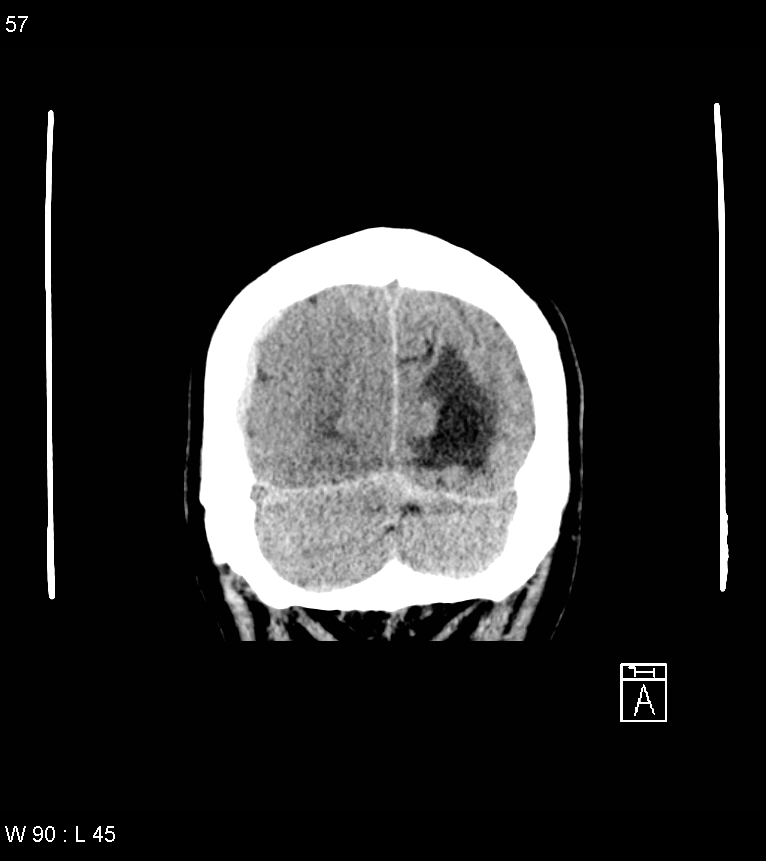 Acute subdural hematoma with myelofibrosis (Radiopaedia 52582-58494 Coronal non-contrast 48).jpg