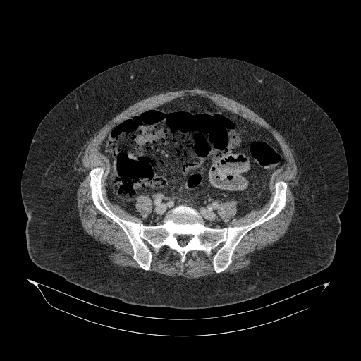 Acute superior mesenteric artery occlusion (Radiopaedia 51288-56960 Axial C+ portal venous phase 74).jpg