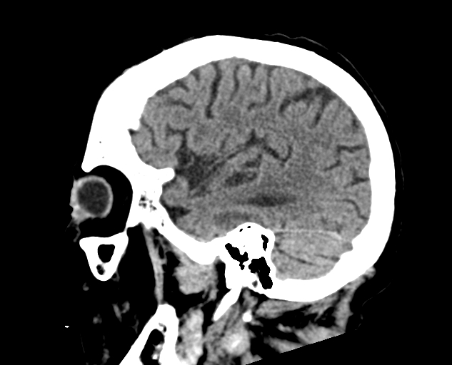 Acute traumatic subdural hematoma (Radiopaedia 82921-97257 Sagittal non-contrast 22).jpg