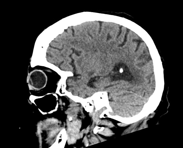 Acute traumatic subdural hematoma (Radiopaedia 82921-97257 Sagittal non-contrast 51).jpg