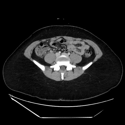 Acute uncomplicated appendicitis (Radiopaedia 73704-84499 Axial C+ portal venous phase 103).jpg