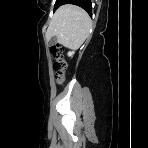 Acute uncomplicated appendicitis (Radiopaedia 73704-84499 Sagittal C+ portal venous phase 65).jpg