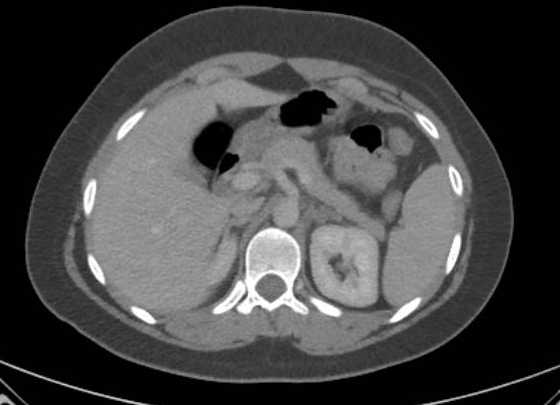 Acute unilateral nonhemorrhagic adrenal infarction (Radiopaedia 67560-76957 Axial renal parenchymal phase 36).jpg