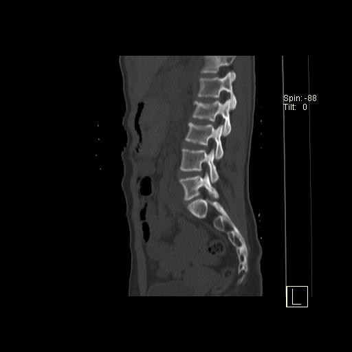 File:Acute vertebral compression fracture (Radiopaedia 63832-72559 Sagittal bone window 5).jpg