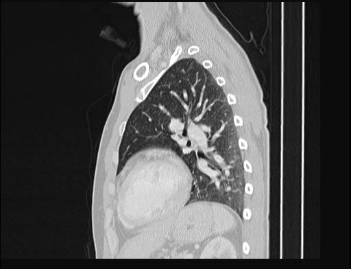 File:Addison disease (Radiopaedia 49318-54412 Sagittal lung window 20).jpg