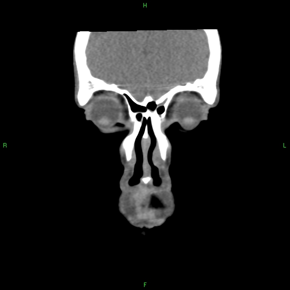 File:Adenoid cystic carcinoma of hard palate (Radiopaedia 26137-26273 Coronal liver window 2).jpg
