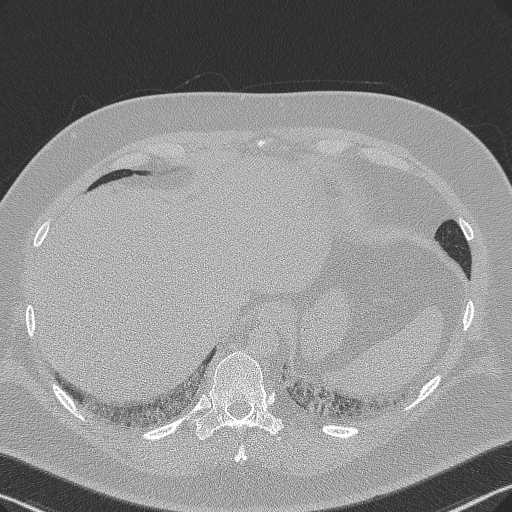 Adenoid cystic carcinoma of the trachea (Radiopaedia 49042-54137 Axial lung window 295).jpg