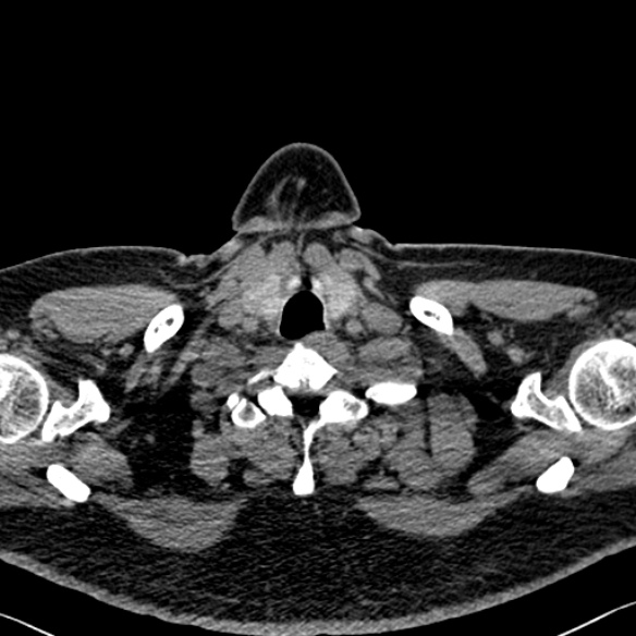 File:Adenoid cystic carcinoma of the trachea (Radiopaedia 49042-54137 Axial non-contrast 3).jpg