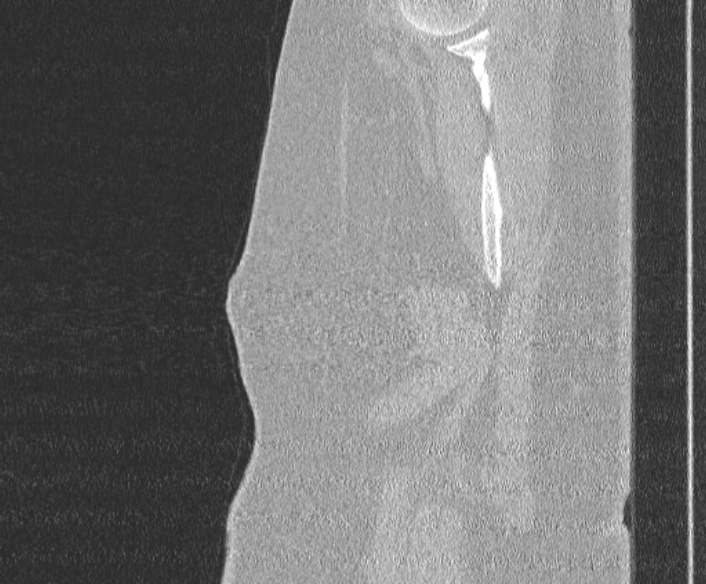 Adenoid cystic carcinoma of the trachea (Radiopaedia 49042-54137 Sagittal lung window 3).jpg