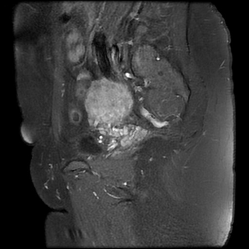 File:Adenomyosis-scar endometriosis (Radiopaedia 65863-75022 Sagittal T1 C+ fat sat 20).jpg