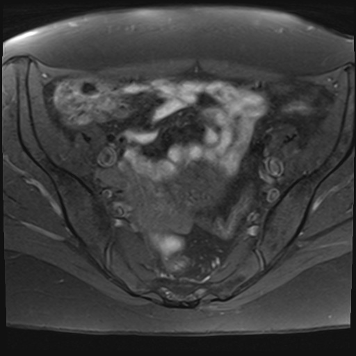 File:Adenomyosis and endometriotic cysts (Radiopaedia 82300-96367 Axial T1 fat sat 21).jpg