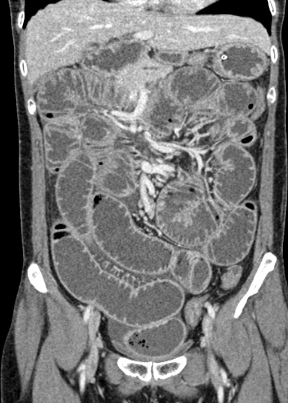 Adhesional small bowel obstruction (Radiopaedia 48397-53305 Coronal C+ portal venous phase 134).jpg