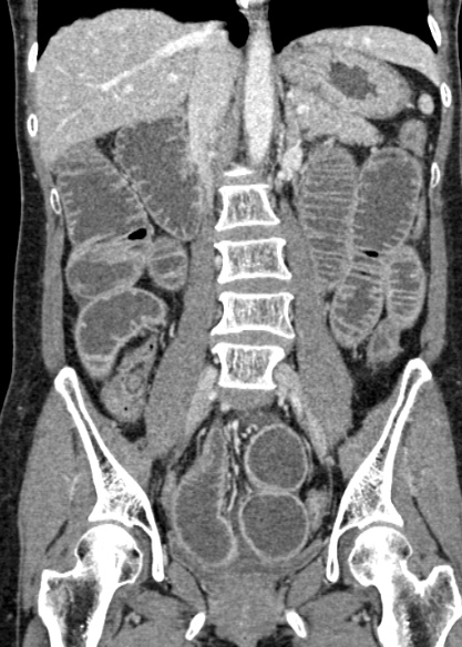 File:Adhesional small bowel obstruction (Radiopaedia 48397-53305 Coronal C+ portal venous phase 196).jpg