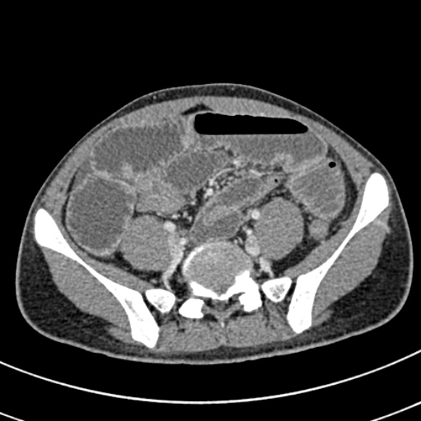 Adhesional small bowel obstruction (Radiopaedia 52107-57980 Axial C+ portal venous phase 90).jpg