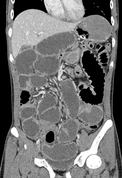 Adhesional small bowel obstruction (Radiopaedia 52107-57980 Coronal C+ portal venous phase 30).jpg