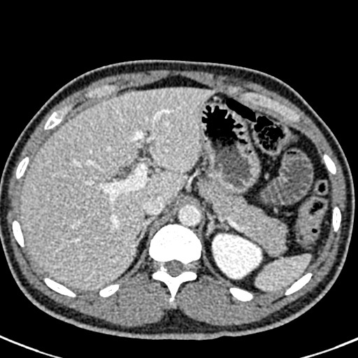 Adhesional small bowel obstruction (Radiopaedia 58900-66131 Axial C+ portal venous phase 12).jpg