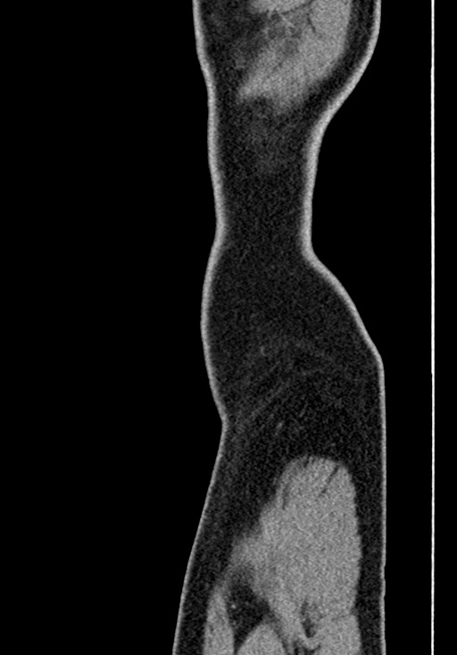 Adhesional small bowel obstruction (Radiopaedia 58900-66131 Sagittal C+ portal venous phase 5).jpg