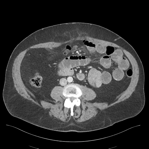 Adhesions within abdominal wall hernia (Radiopaedia 58283-65394 Axial C+ portal venous phase 47).png