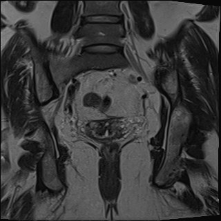 File:Adnexal multilocular cyst (O-RADS US 3- O-RADS MRI 3) (Radiopaedia 87426-103754 Coronal T2 22).jpg